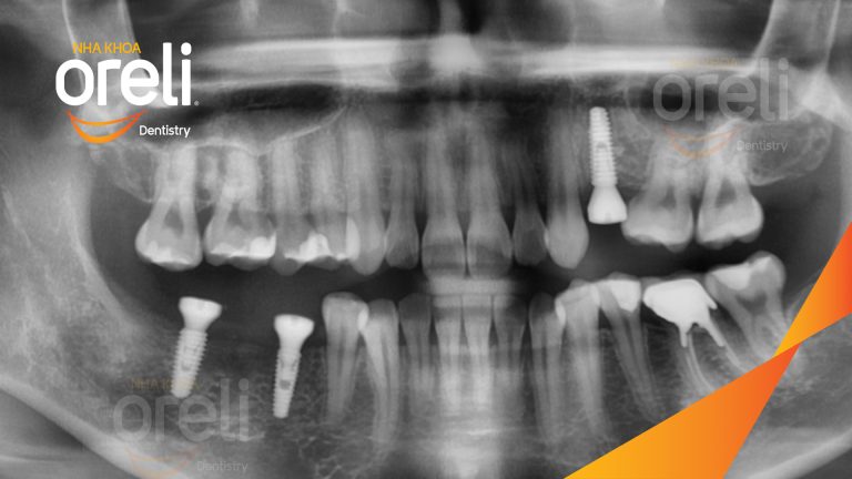 Ca Cấy Ghép Implant Phục Hồi Răng Mất Tại Nha Khoa Oreli