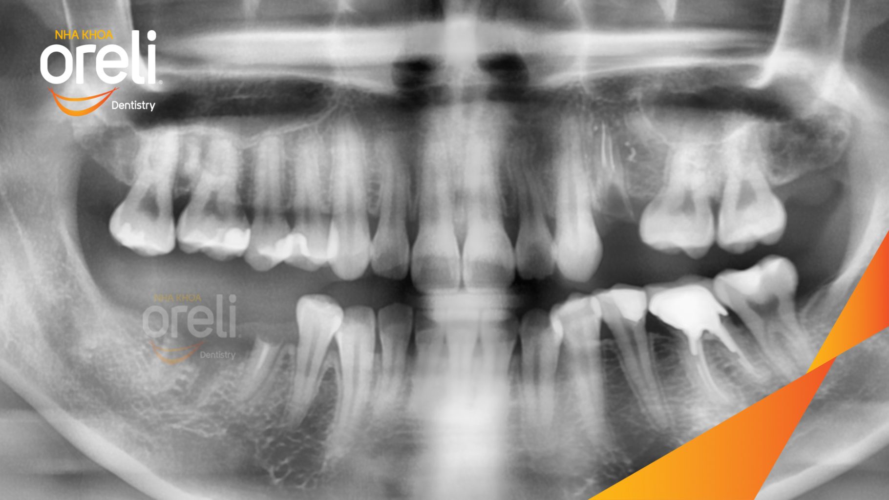 Trước điều trị: Mất răng hàm dưới tại Oreli