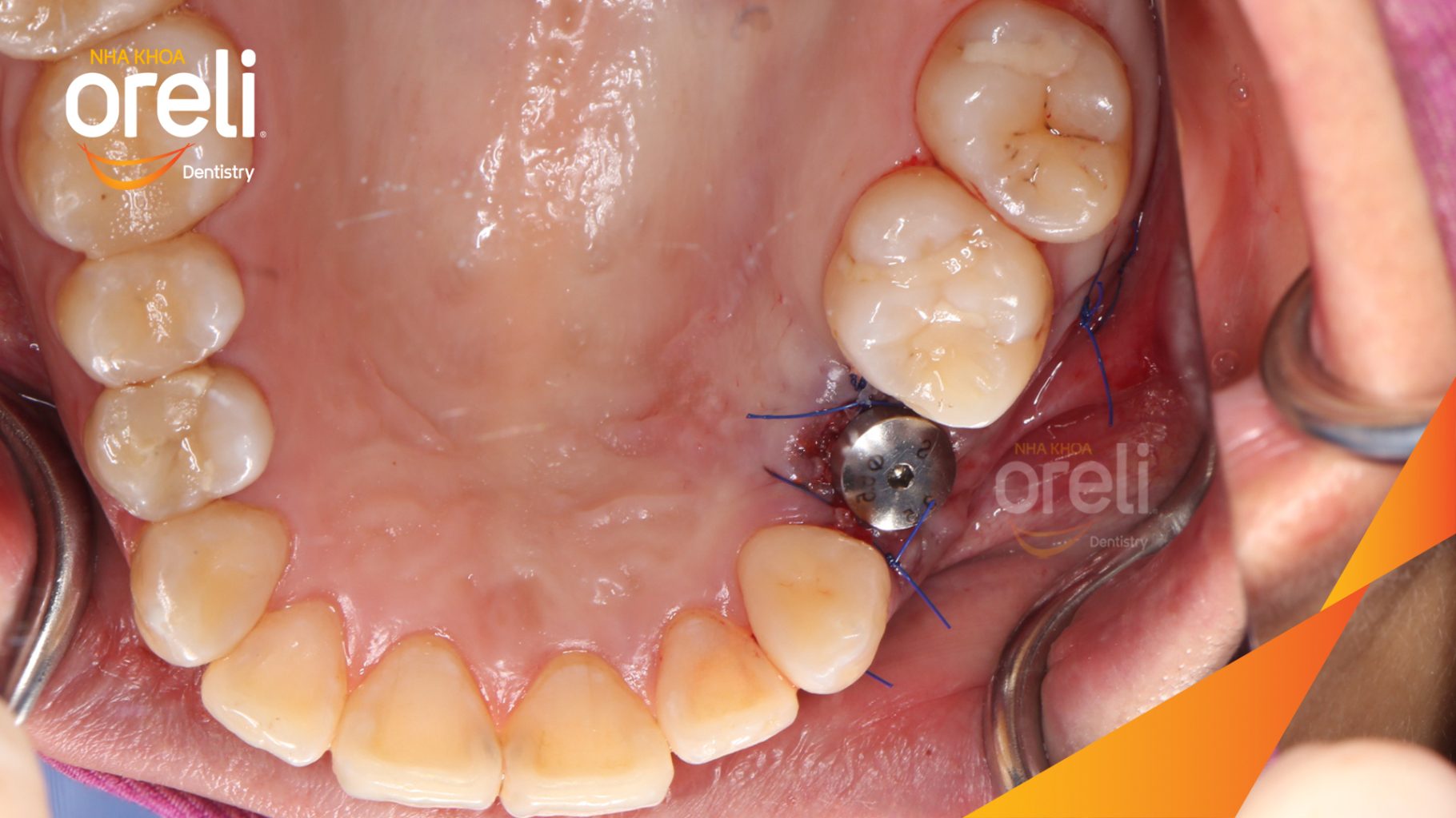 Quá trình Cấy ghép trụ Implant chính hãng vào vùng mất răng trong 3 tháng tại Oreli