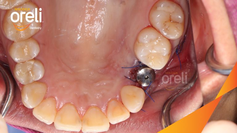 Ca Cấy Ghép Implant Phục Hồi Răng Mất Tại Nha Khoa Oreli