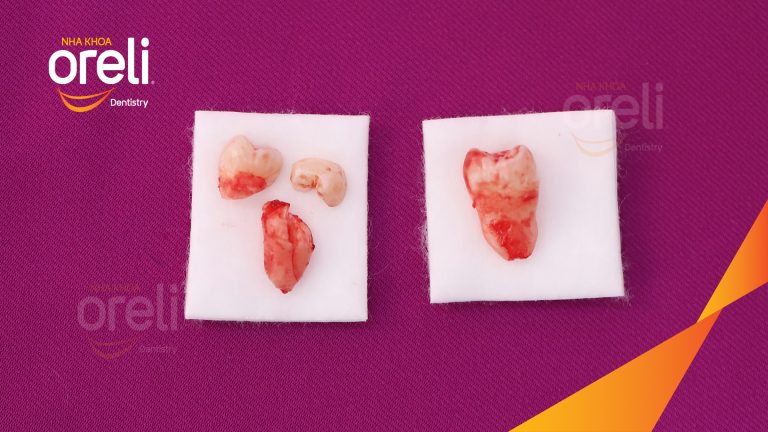Nhổ răng khôn hàm dưới – Case tại Oreli Buôn Ma Thuột