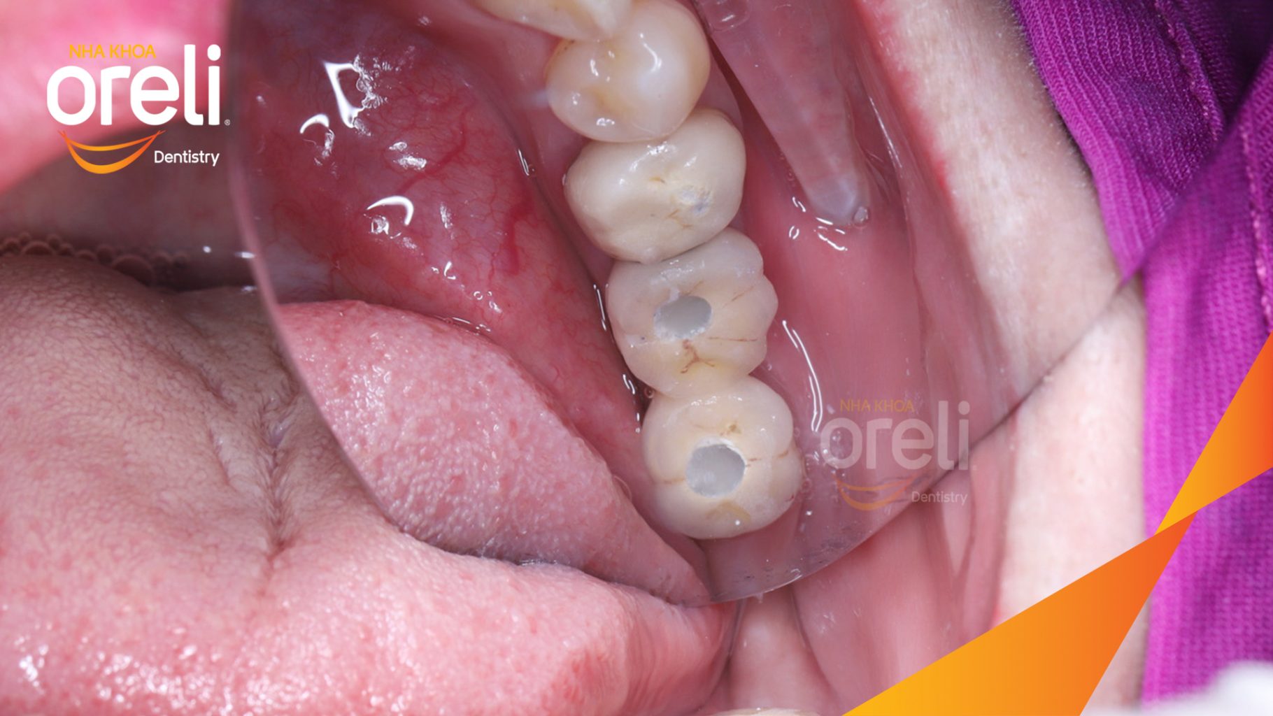 Mất răng hàm dưới trước khi điều trị tại Oreli