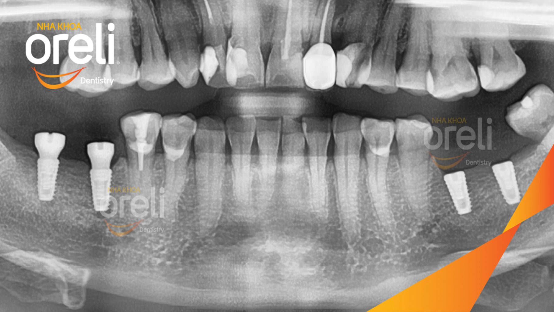 Mất răng hàm dưới trước khi điều trị tại Oreli