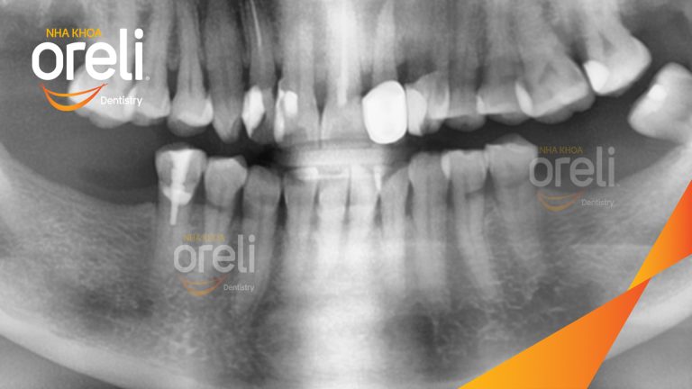 Ca Cấy Ghép Implant Phục Hồi Răng Tại Nha Khoa Oreli