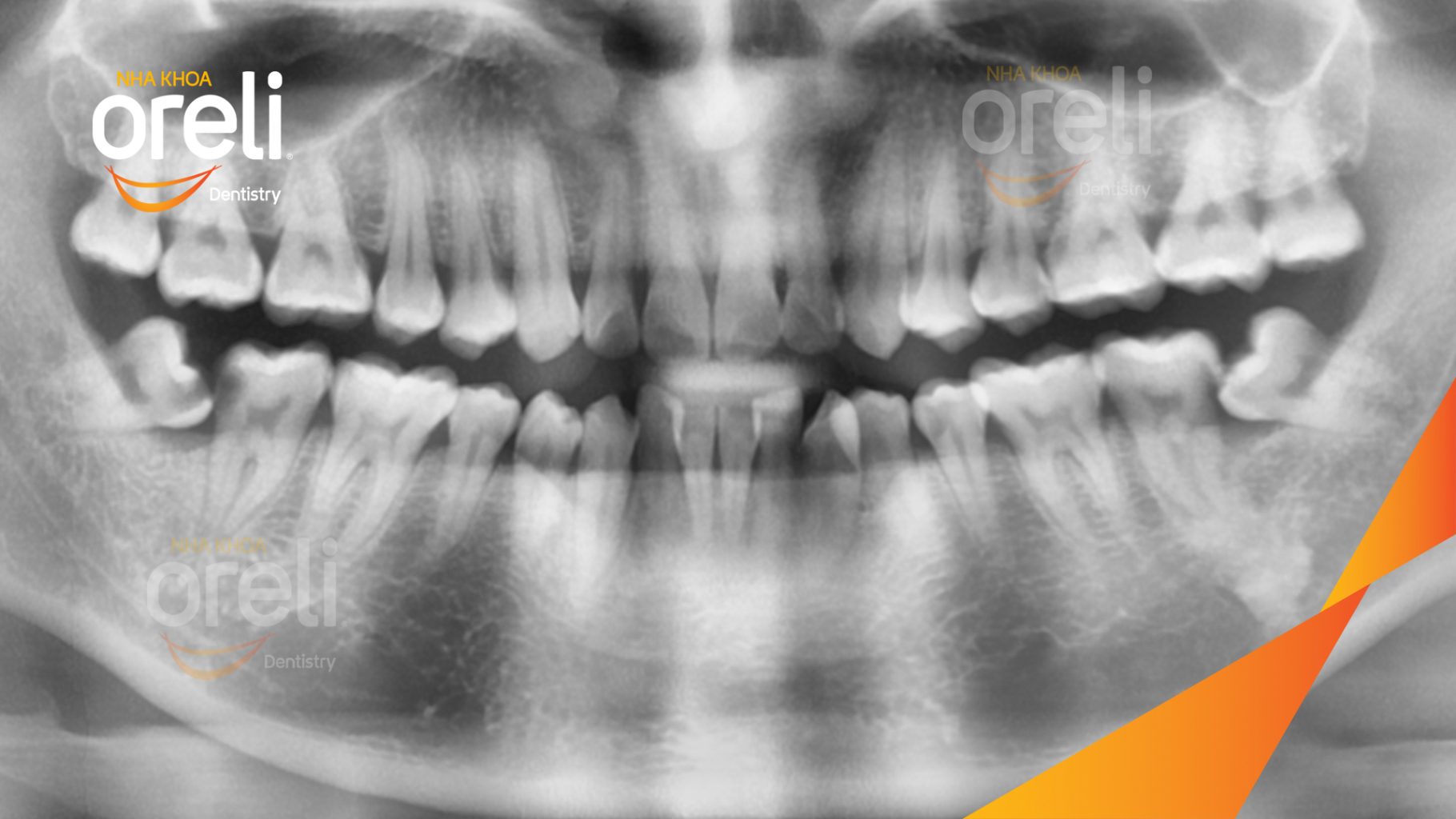 Trước điều trị: Răng khôn hàm dưới mọc lệch tại Oreli