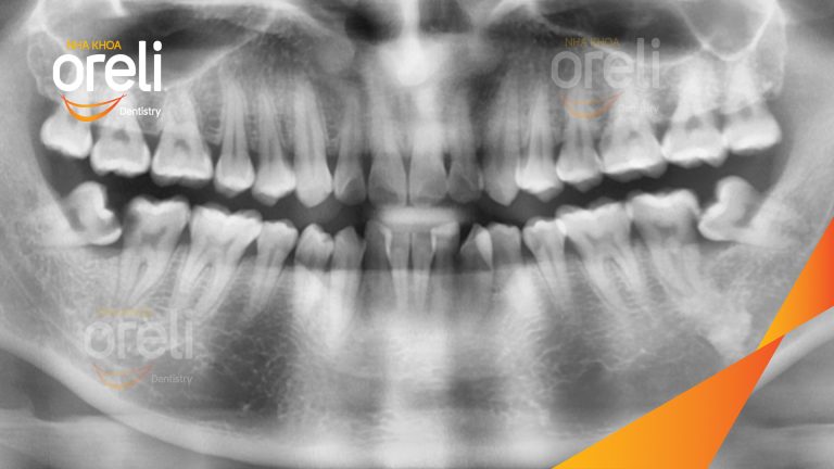 Nhổ răng khôn hàm dưới – Case thực tế tại Oreli Buôn Ma Thuột