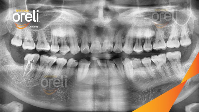 Nhổ răng khôn hàm dưới – Case thực tế tại Oreli Buôn Ma Thuột