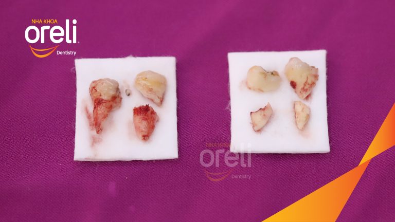 Nhổ răng khôn hàm dưới – Case thực tế tại Oreli Buôn Ma Thuột
