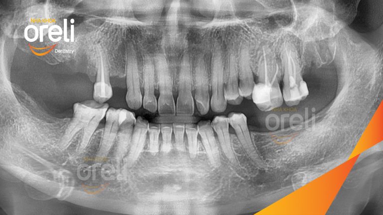 Ca Cấy Ghép Implant Phục Hồi Răng Tại Nha Khoa Oreli