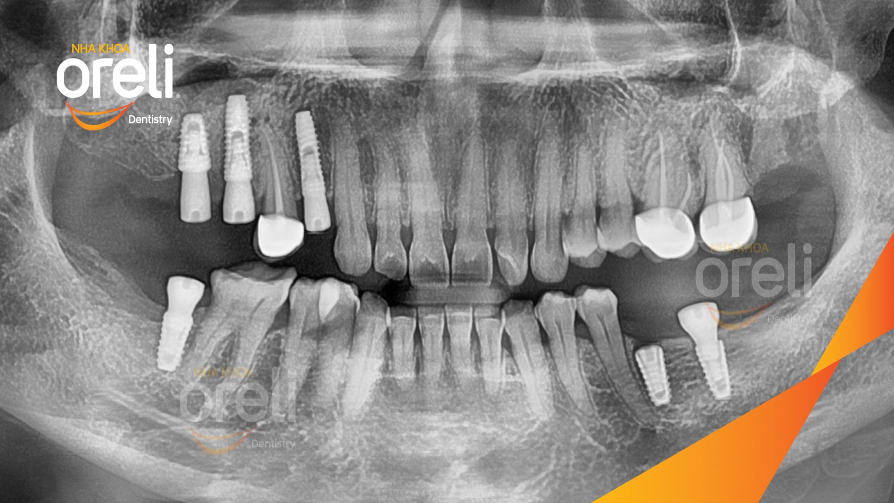 Mất răng hàm trên và dưới trước khi điều trị tại Oreli