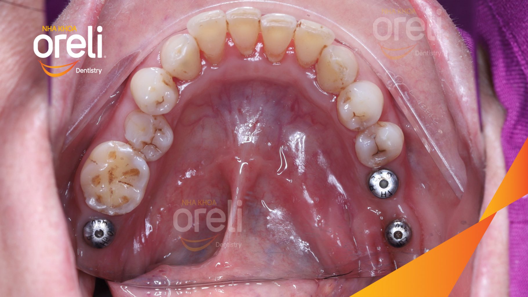 Quá trình Cấy ghép trụ Implant chính hãng vào vùng mất răng trong 3 tháng tại Oreli