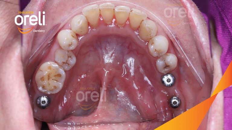 Ca Cấy Ghép Implant Phục Hồi Răng Tại Nha Khoa Oreli