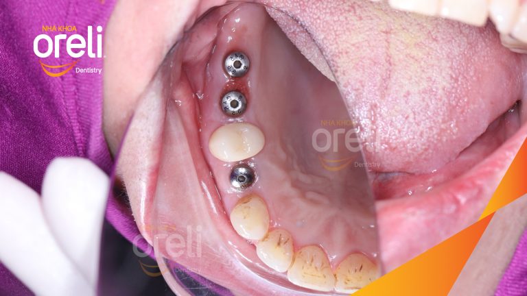 Ca Cấy Ghép Implant Phục Hồi Răng Tại Nha Khoa Oreli