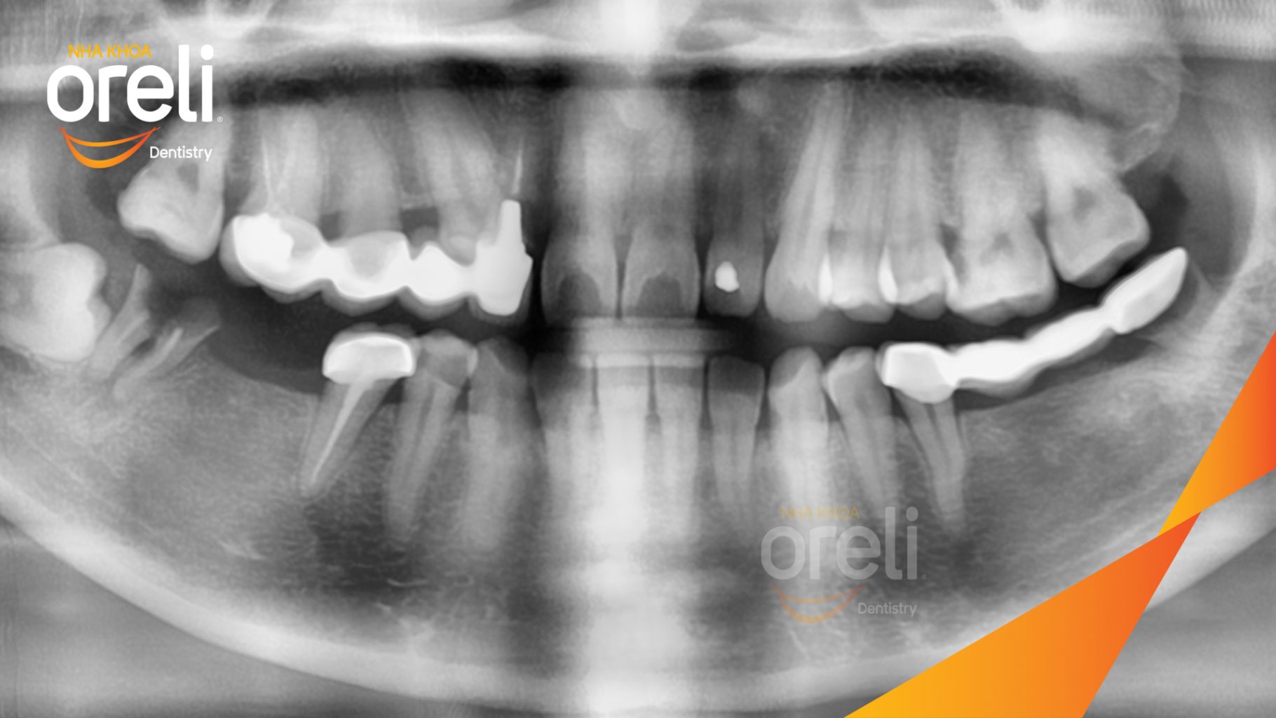 Trước điều trị: Mất răng hàm dưới tại Oreli