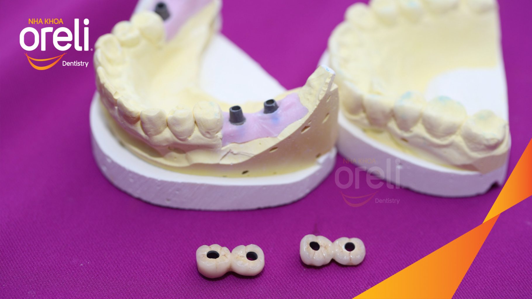 Kết quả sau 3 tháng: Phục hồi răng mất - ăn nhai chắc chắn và cười nói tự tin tại Oreli