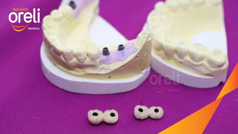 Ca Cấy Ghép Implant Hàm Dưới – Case thực tế tại Oreli