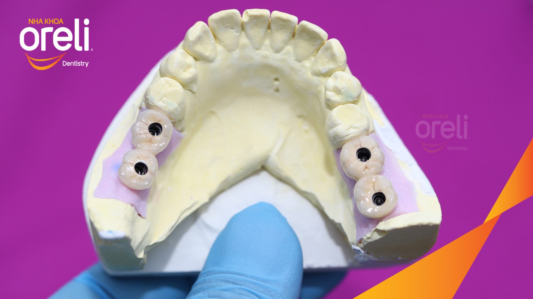 Kết quả đạt được sau 3 tháng - Phục hồi răng mất - ăn nhai chắc chắn và cười nói tự tin tại Oreli