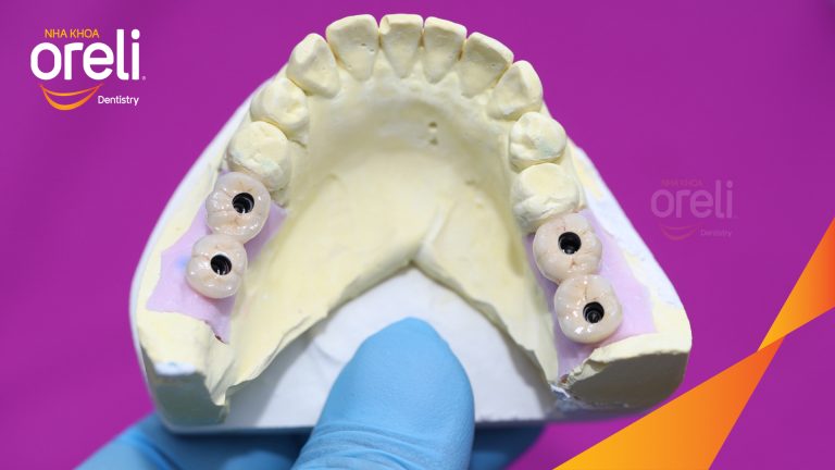 Ca Cấy Ghép Implant Hàm Dưới – Case thực tế tại Oreli