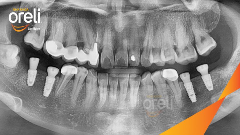 Ca Cấy Ghép Implant Hàm Dưới – Case thực tế tại Oreli