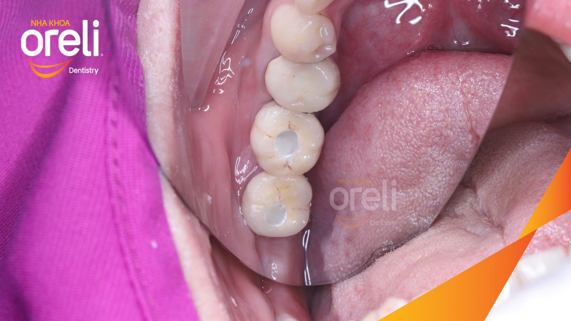 Trước điều trị: Mất răng hàm dưới tại Oreli