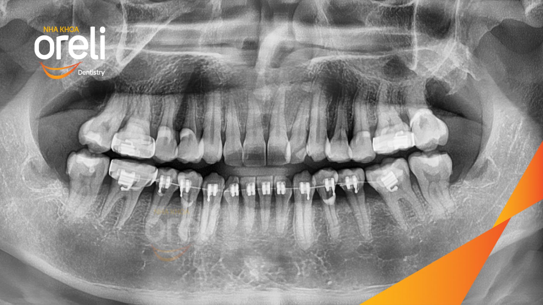 Răng khôn mọc lệch trước khi điều trị tại Oreli