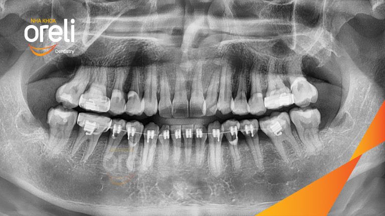 Ca Nhổ Răng Khôn Mọc Lệch Tại Buôn Ma Thuột | Nha khoa Oreli