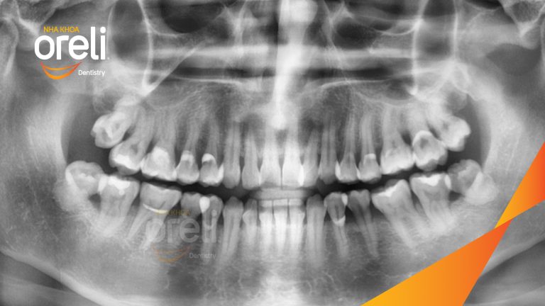 Ca Nhổ Răng Khôn Mọc Lệch Tại Buôn Ma Thuột | Nha khoa Oreli