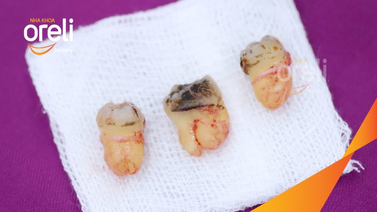 Ca Nhổ Răng Khôn Mọc Lệch Tại Buôn Ma Thuột | Nha khoa Oreli