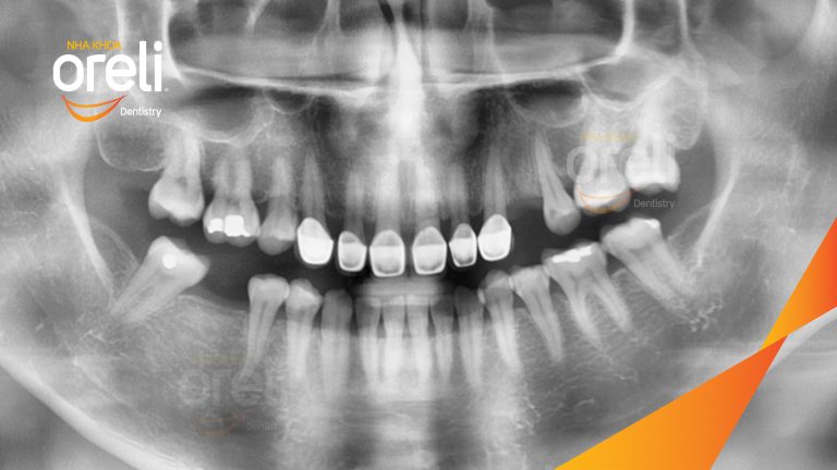 Ca Cấy Ghép Implant Phục Hồi Răng Tại Nha Khoa Oreli