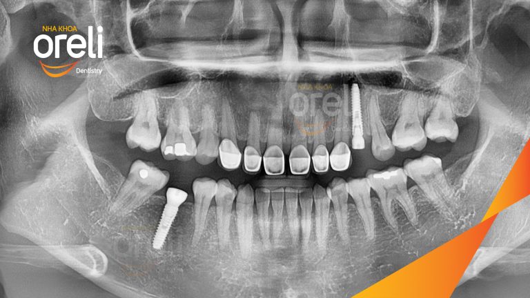 Ca Cấy Ghép Implant Phục Hồi Răng Tại Nha Khoa Oreli