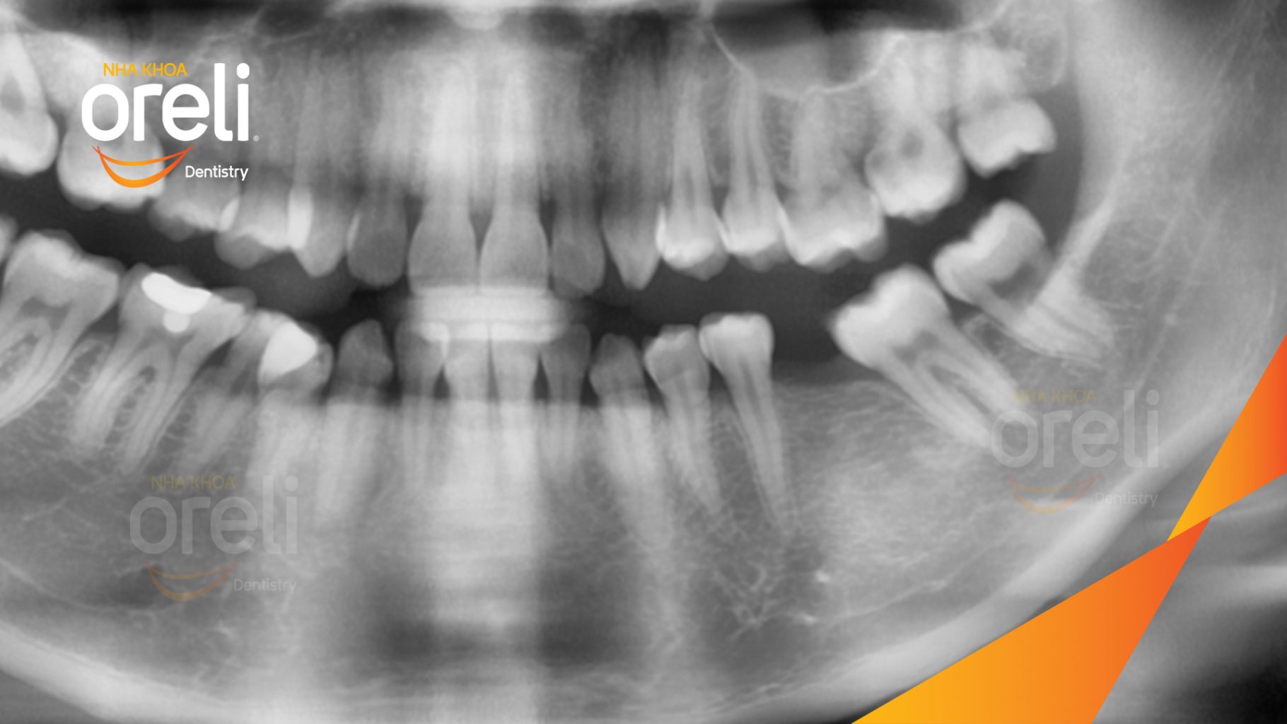 Trước điều trị: Mất răng hàm dưới tại Oreli