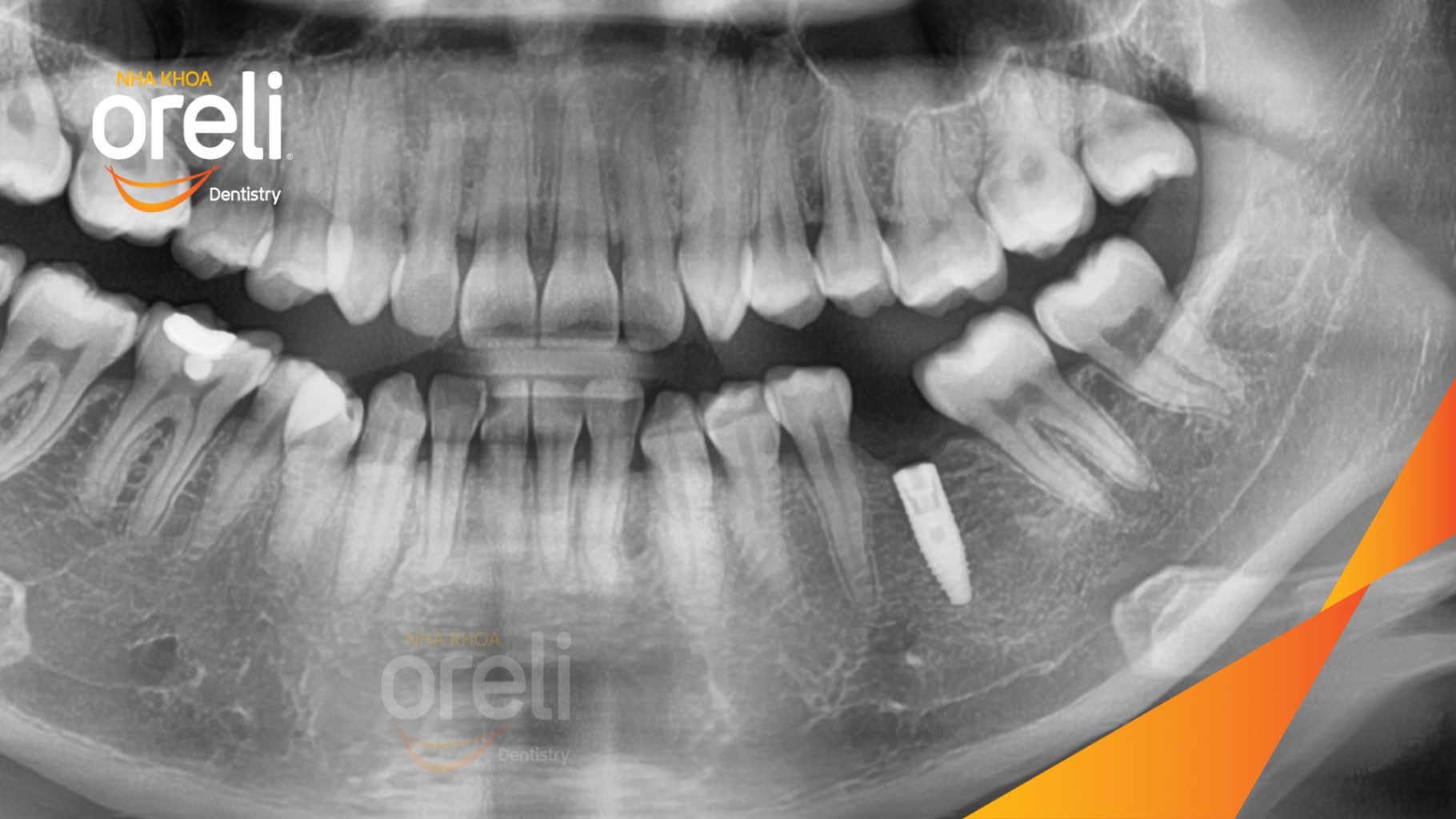 Mất răng hàm dưới trước khi điều trị tại Oreli