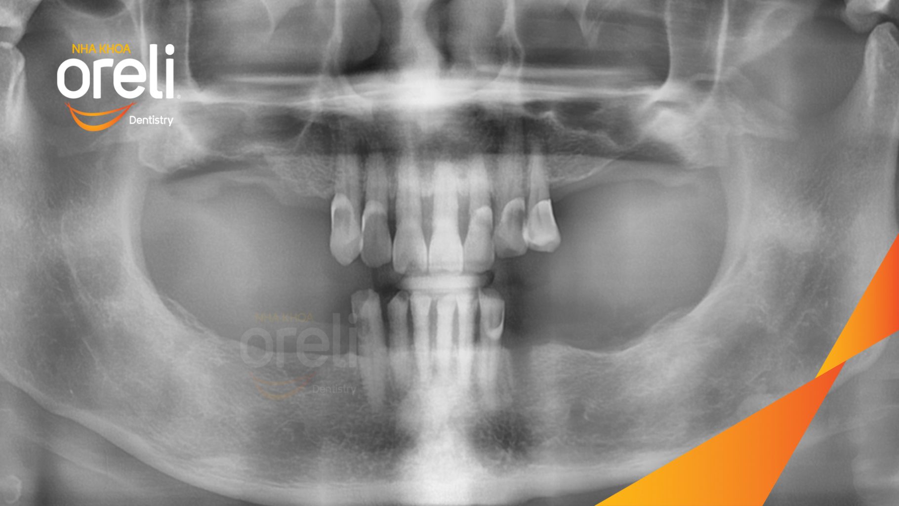 Trước điều trị: Mất nhiều răng hàm trên và dưới tại Oreli