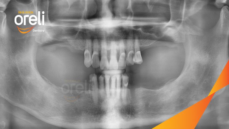Ca Cấy Ghép Implant Phục Hồi Răng Tại Nha Khoa Oreli