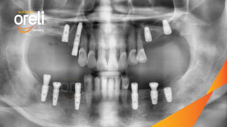 Ca Cấy Ghép Implant Phục Hồi Răng Tại Nha Khoa Oreli