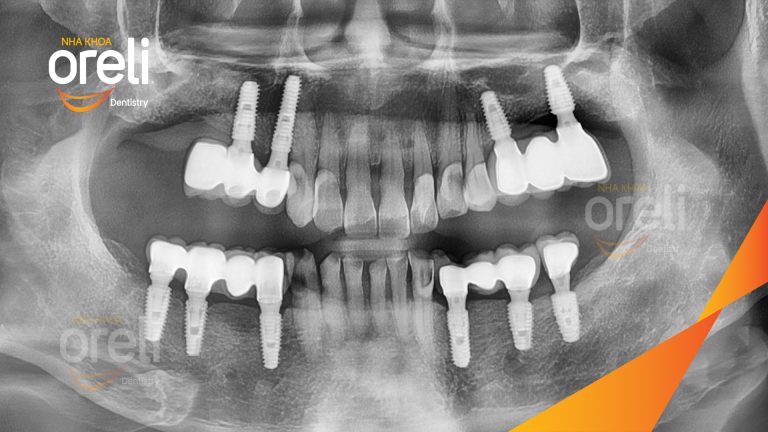 Ca Cấy Ghép Implant Phục Hồi Răng Tại Nha Khoa Oreli