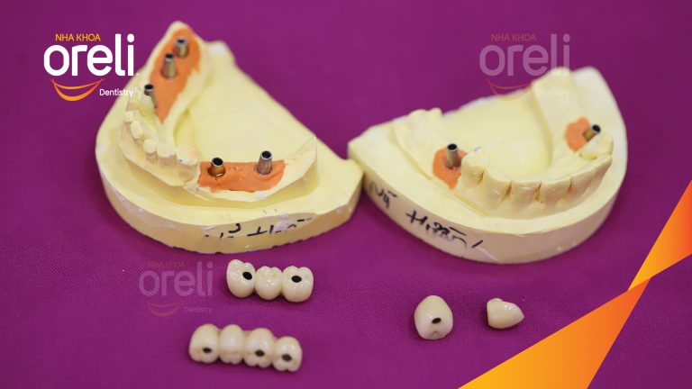 Ca Cấy Ghép Implant Phục Hồi Răng Tại Nha Khoa Oreli