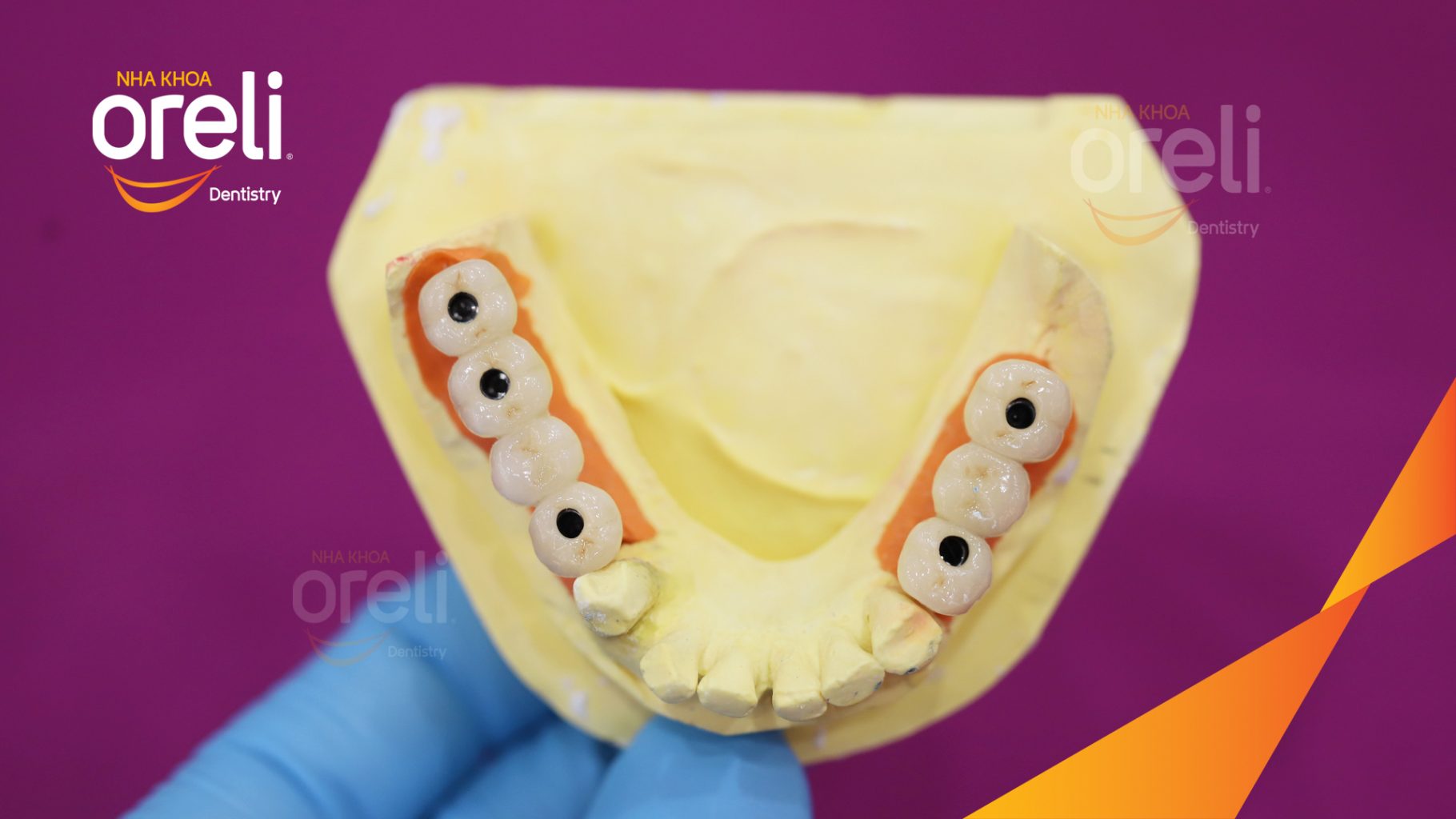 Kết quả đạt được sau 3 tháng - Phục hồi răng mất - ăn nhai chắc chắn và cười nói tự tin tại Oreli