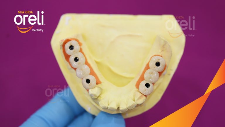 Ca Cấy Ghép Implant Phục Hồi Răng Tại Nha Khoa Oreli