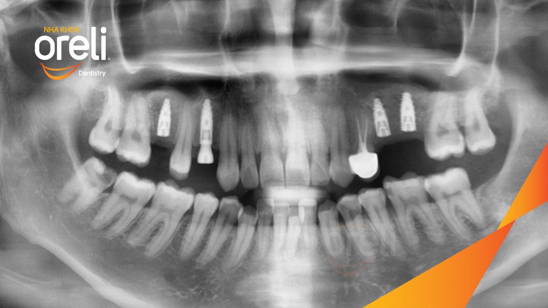 Mất răng hàm trên trước khi điều trị tại Oreli
