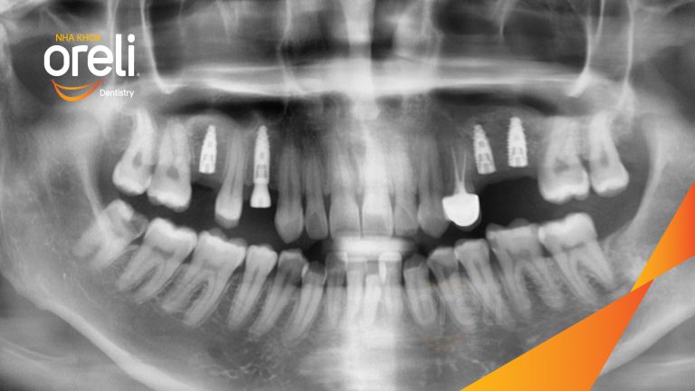 Ca Cấy Ghép Implant Hàm Trên – Case thực tế tại Oreli