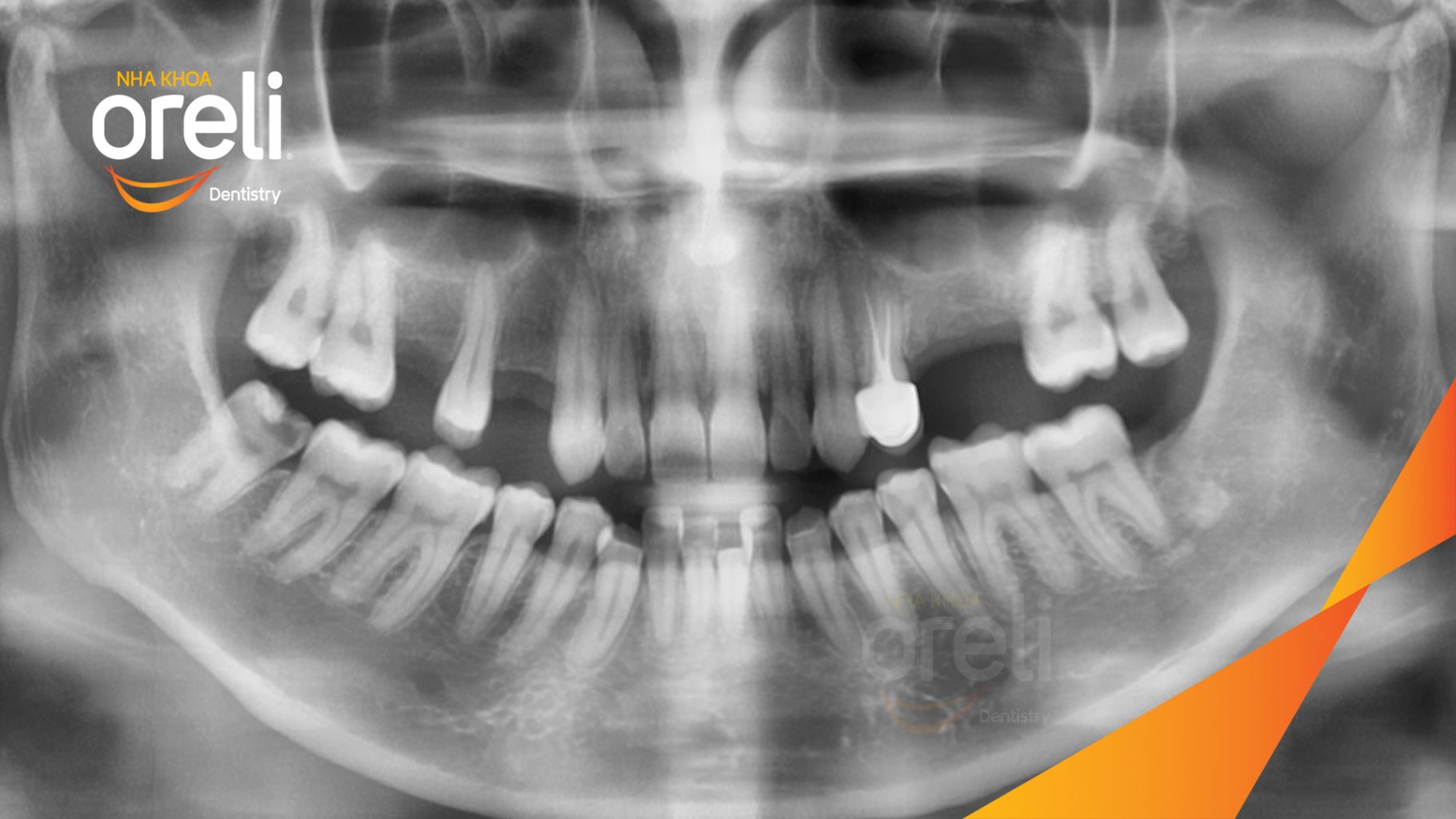 Trước điều trị: Mất răng hàm trên tại Oreli