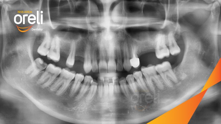 Ca Cấy Ghép Implant Hàm Trên – Case thực tế tại Oreli
