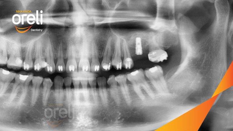 Ca Cấy Ghép Implant Phục Hồi Răng Tại Nha Khoa Oreli