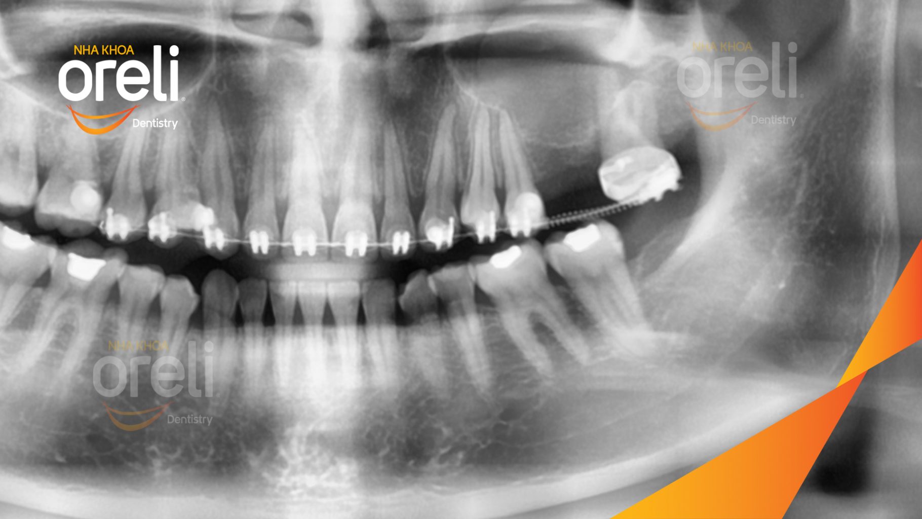 Trước điều trị: Mất răng hàm trên tại Oreli
