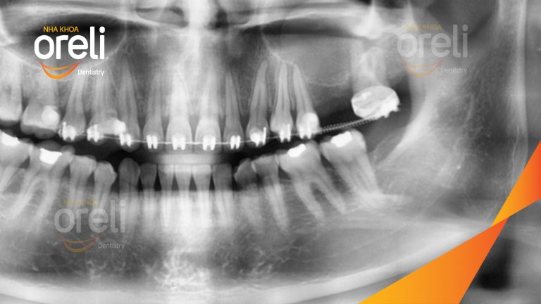 Ca Cấy Ghép Implant Phục Hồi Răng Tại Nha Khoa Oreli