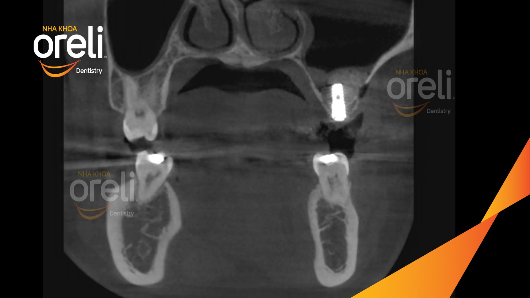 Thực hiện Cấy ghép trụ Implant chính hãng vào vùng mất răng kéo dài 3 tháng tại Oreli