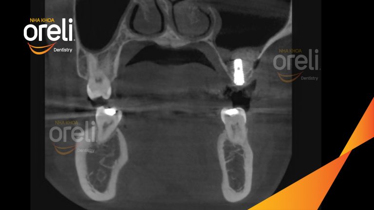Ca Cấy Ghép Implant Phục Hồi Răng Tại Nha Khoa Oreli
