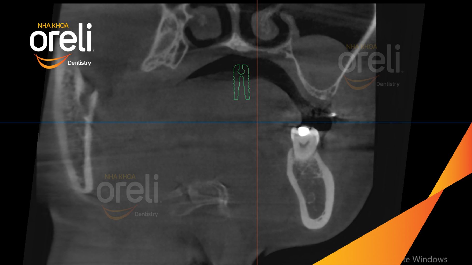 Quá trình Cấy ghép trụ Implant chính hãng vào vùng mất răng trong 3 tháng tại Oreli