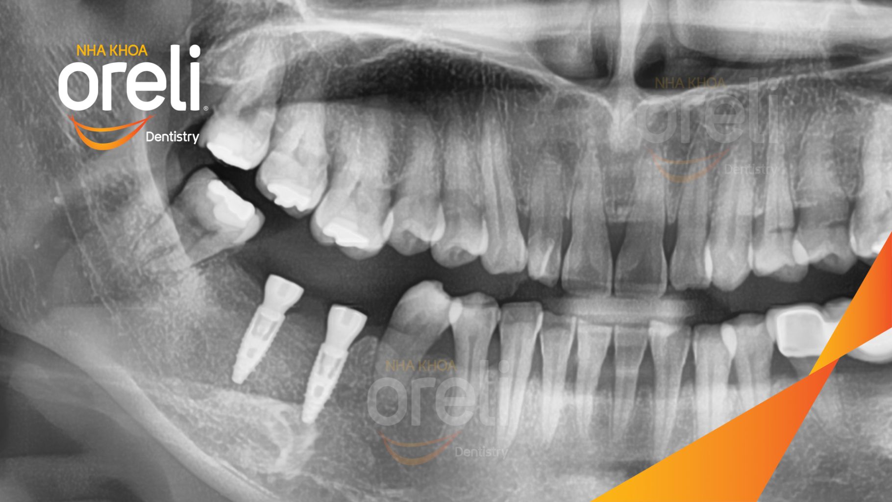 Mất răng hàm dưới trước khi điều trị tại Oreli